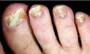 Az onychomycosis veszélye