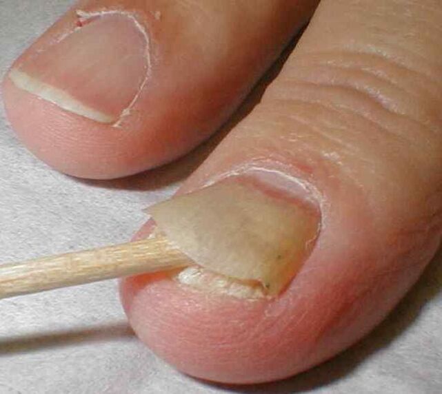 gombák körmök lábakon gyógyítani gyors hatékony kezelés eljárás köröm gomba a lábak