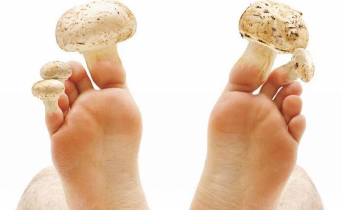 láb és a köröm gombás hatásos kezelése gomba a körmökre, mit tegyen