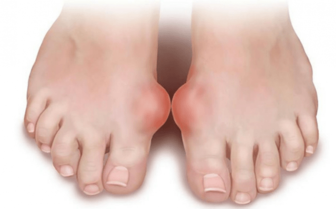 a láb deformitása, mint a gomba megjelenésének oka a lábakon