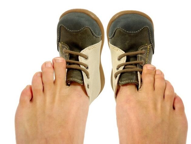 a feszes cipő, mint a lábujjak közötti gomba oka