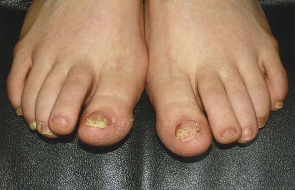 nail deformációja láb gombás