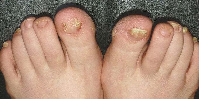 A lábak körmének onychomycosis
