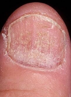 A szög mycosis