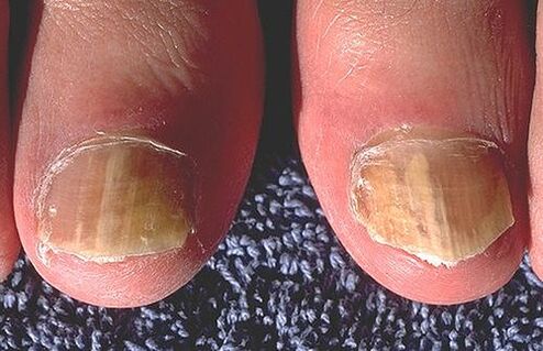 A dermatofiták által érintett körmök