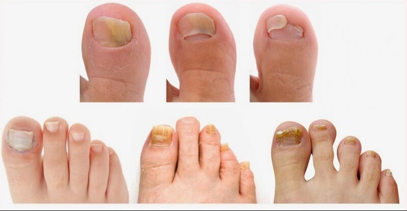 Az onychomycosis első jelei