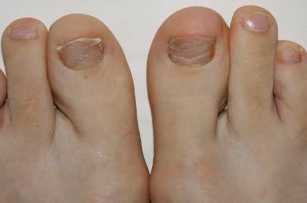 A tünetek a láb gombás